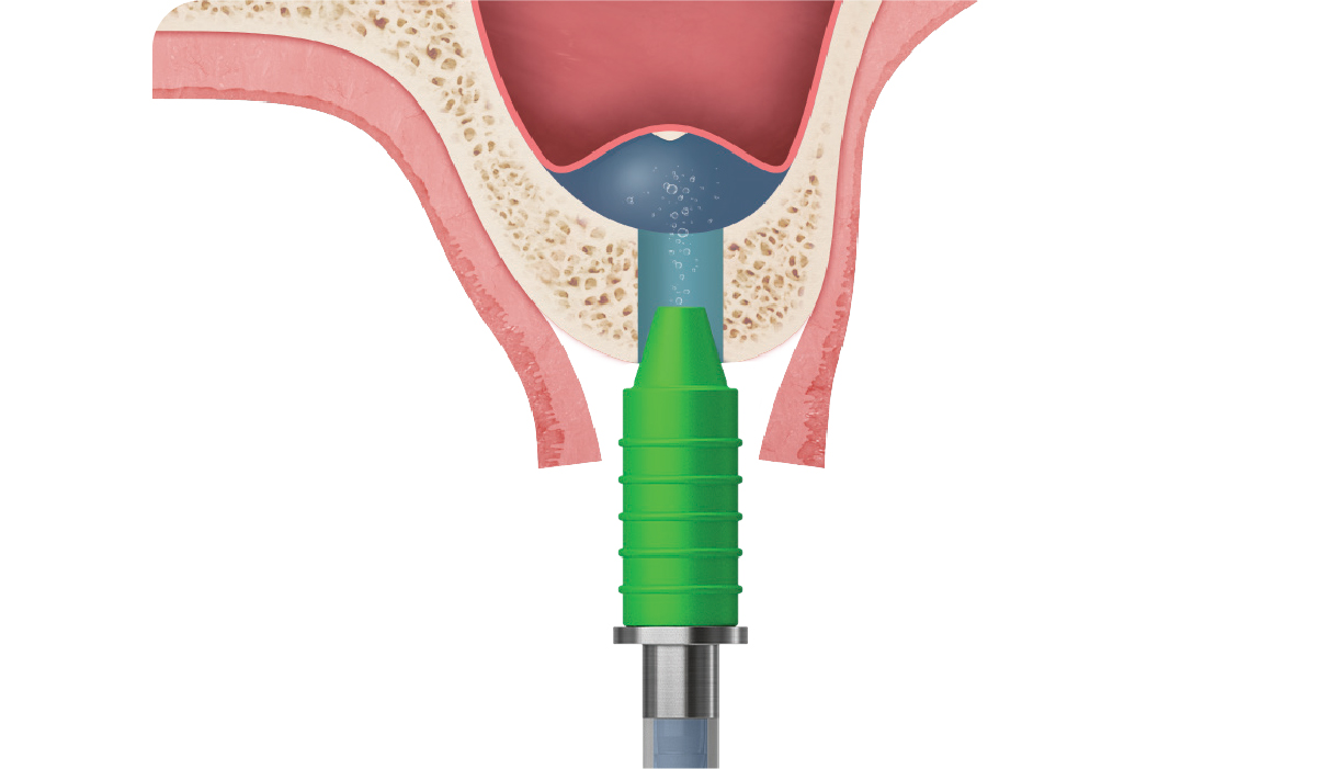 Safely lifts membrane with hydraulic pressure
