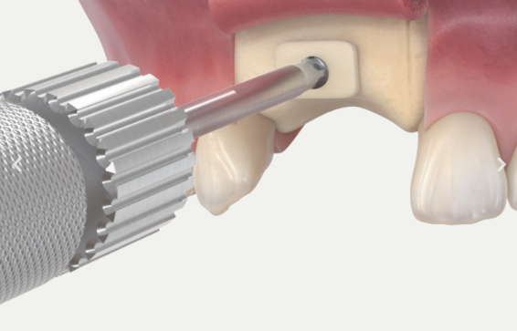 Fixing Block bone