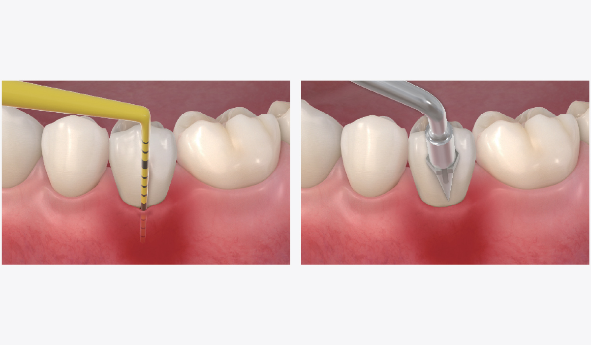 In case of mucositis
