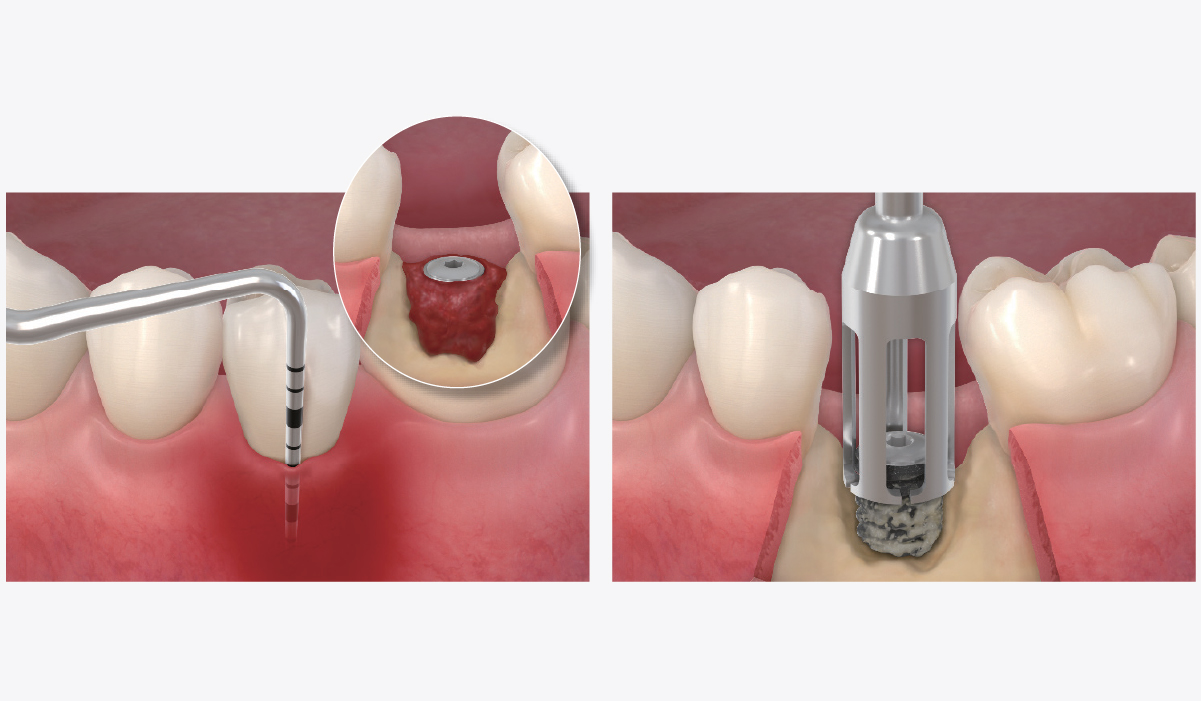 Peri implantitis with vertical bone resorption