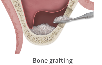 Minimizes the risk of membrane perforation